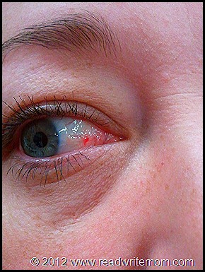 I have a broken blood vessel in my eye.