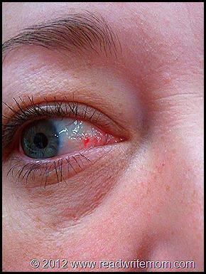 broken blood vessel in eye